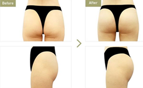 豐臀和提臀有什么區(qū)別?提臀有什么風(fēng)險?