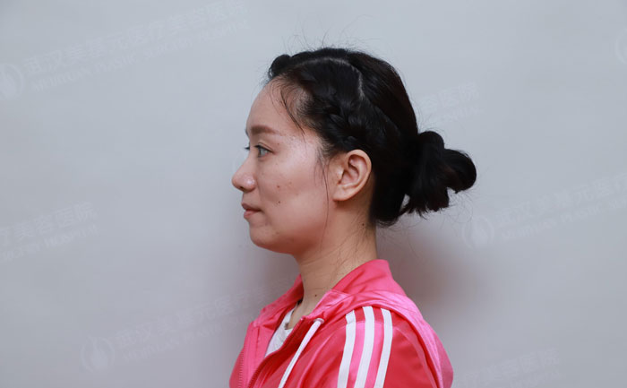 顴骨突出怎樣改善？