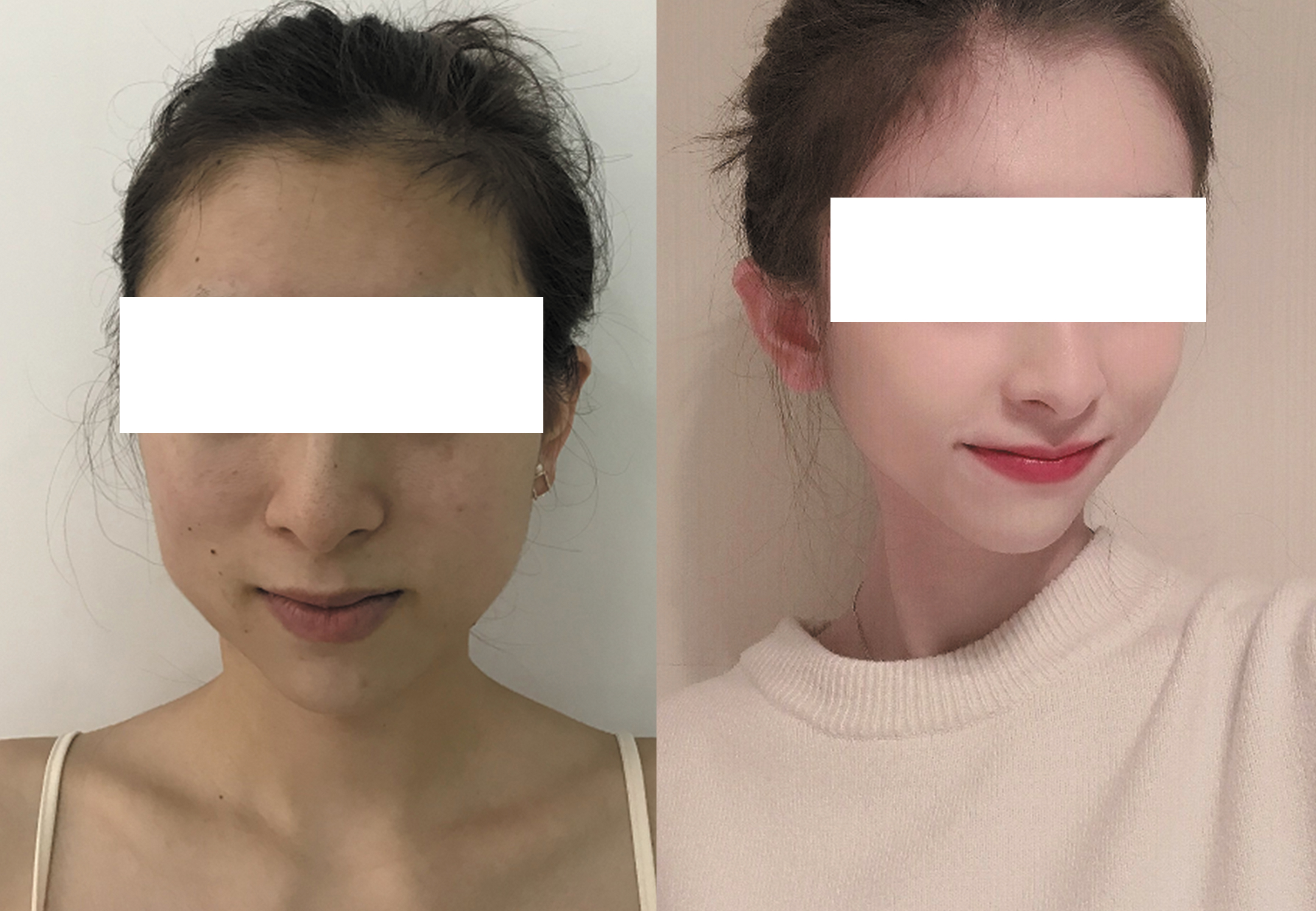 合肥藝星周海林醫(yī)生手術(shù)效果圖3