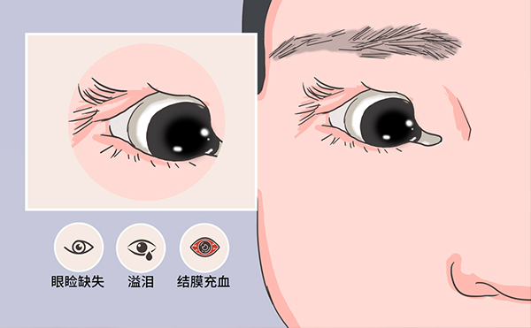 先天性眼瞼缺損會遺傳嗎?先天性眼瞼缺損怎么辦?