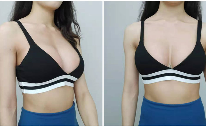 隆胸失敗多久可以做修復(fù)手術(shù)？隆胸手術(shù)失敗修復(fù)多少錢