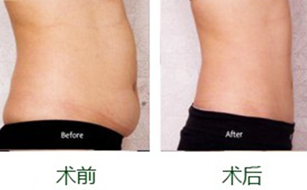 產(chǎn)后減肥可以做腹部吸脂嗎？