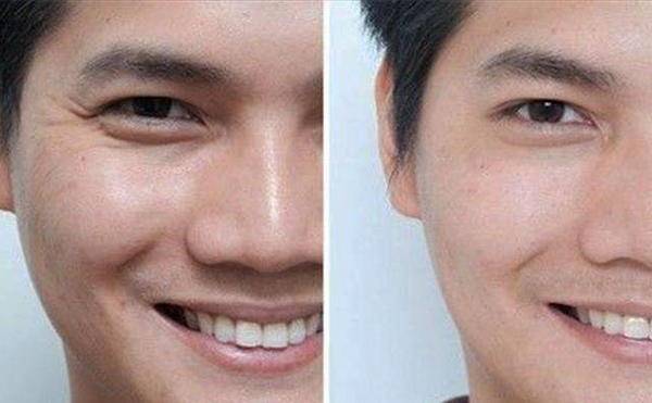 玻尿酸眼部除皺效果怎么樣？