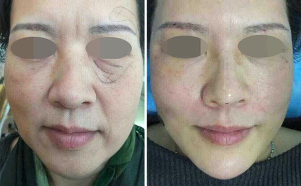 筋膜懸吊安全嗎？