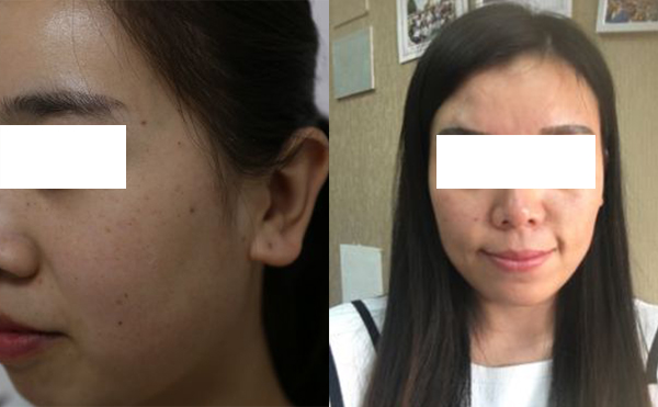 激光和光子嫩膚哪個(gè)祛斑效果好？怎么選擇？