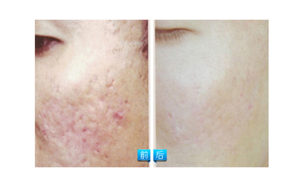 果酸煥膚多少錢？