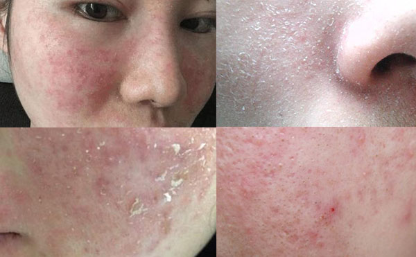 e光嫩膚有什么風(fēng)險(xiǎn)？