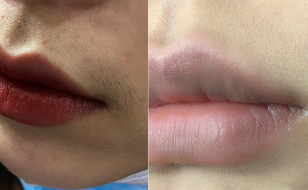 光子脫毛的步驟是什么?光子脫毛的效果怎么樣?