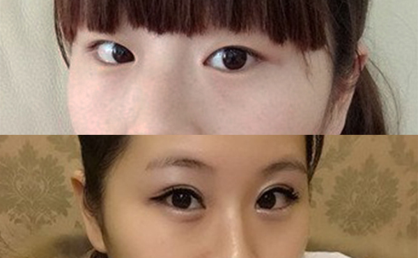 眼綜合安全嗎?有沒(méi)有什么并發(fā)癥?