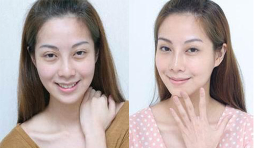 熱瑪吉手術(shù)效果