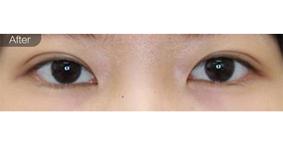 上瞼提肌術(shù)后