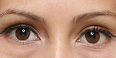 內(nèi)切祛眼袋術(shù)前