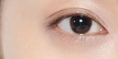 射頻去黑眼圈術(shù)后