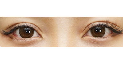 切開(kāi)雙眼皮術(shù)后