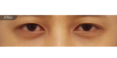 膠原蛋白去黑眼圈術后