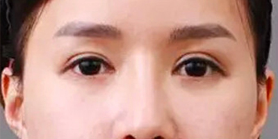 自體脂肪豐臥蠶術(shù)前