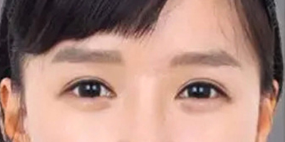 自體脂肪豐臥蠶術(shù)后