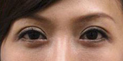 玻尿酸去黑眼圈術后