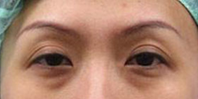 玻尿酸去黑眼圈術前