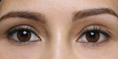 內(nèi)切祛眼袋術(shù)后