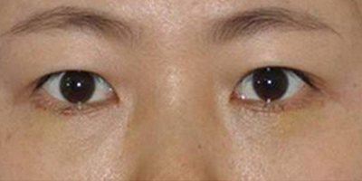 眶隔脂肪釋放術(shù)后