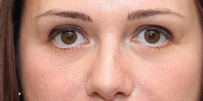 埋線祛眼袋術(shù)后