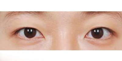定點雙眼皮術(shù)前