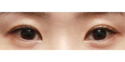下瞼下至術(shù)術(shù)后