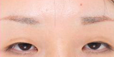 假體墊眉弓術前