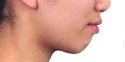 自體脂肪墊下巴術前