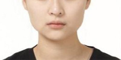 V-LINE瓜子臉手術(shù)術(shù)前