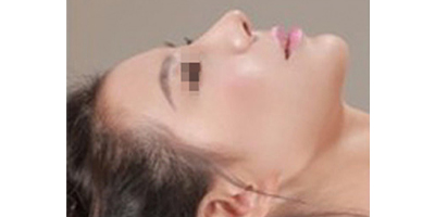 長(zhǎng)鼻矯正術(shù)后