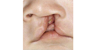 唇腭裂手術(shù)術(shù)前