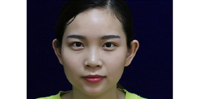 膠原蛋白隆鼻術(shù)前