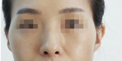 玻尿酸豐太陽穴術(shù)前