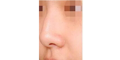駝峰鼻矯正術前
