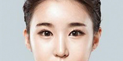 顴骨顴弓整形術術后