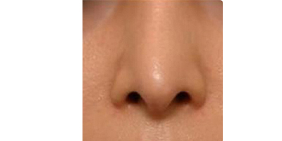 鼻部膨體假體取出術后