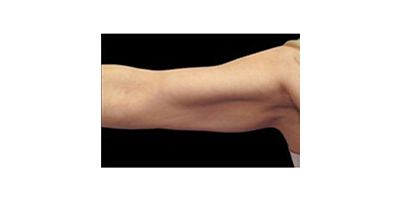 冷凍溶脂瘦手臂術后