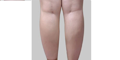 隔空溶脂瘦小腿術前