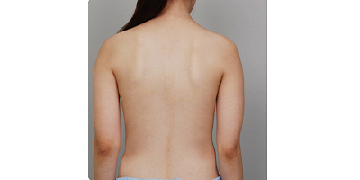 超聲溶脂瘦腰部術(shù)前