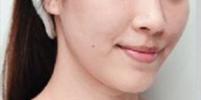 自體脂肪豐蘋果肌術(shù)前