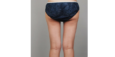 隔空溶脂瘦臀部術后