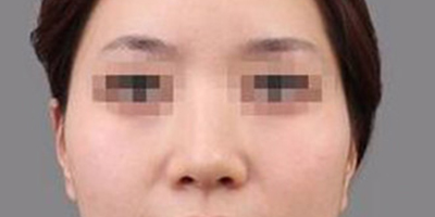 顴骨內(nèi)推術前