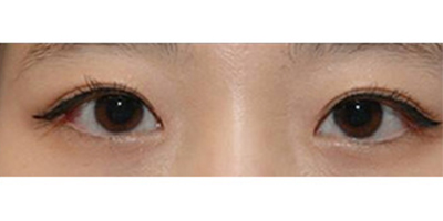 眼部多項術(shù)后