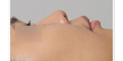 玻尿酸隆鼻術(shù)前