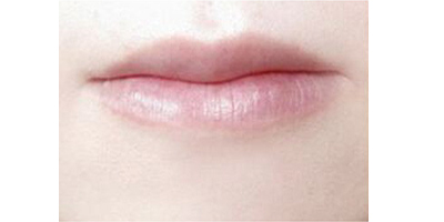 自體脂肪豐唇術(shù)前