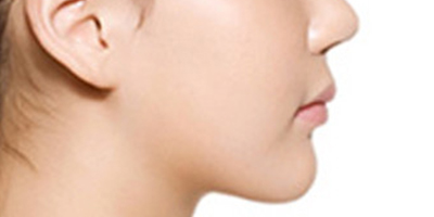 下巴截骨術(shù)術(shù)后