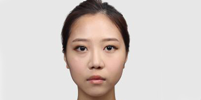 手術(shù)縮鼻翼術(shù)前