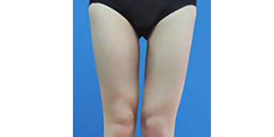 大腿吸脂術(shù)后